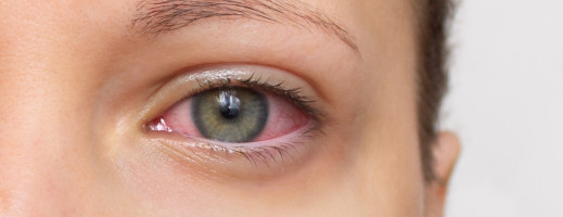 Dry Eye – a Symptom of the Modern Age and a Sign of Disease
