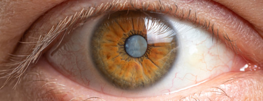 Cataract (Grey Star)