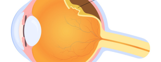 Retina leválása (amóció)